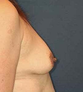 Breast Augmentation Before & After