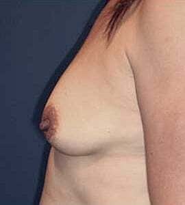 Breast Augmentation Before & After