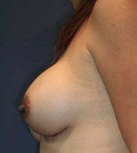 Breast Augmentation Before & After