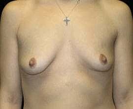 Breast Augmentation Before & After
