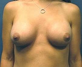 Breast Augmentation Before & After