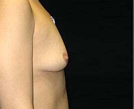 Breast Augmentation Before & After