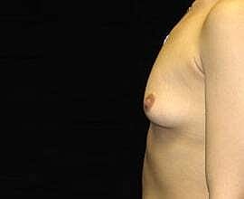 Breast Augmentation Before & After