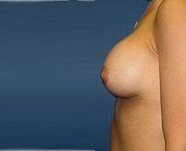 Breast Augmentation Before & After
