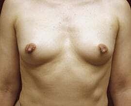 Breast Augmentation Before & After