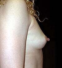 Breast Augmentation Before & After