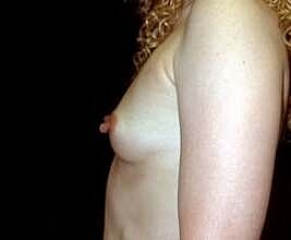 Breast Augmentation Before & After