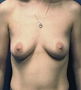 Breast Augmentation Before & After