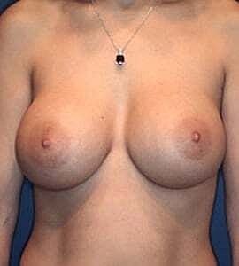 Breast Augmentation Before & After