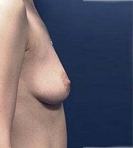 Breast Augmentation Before & After