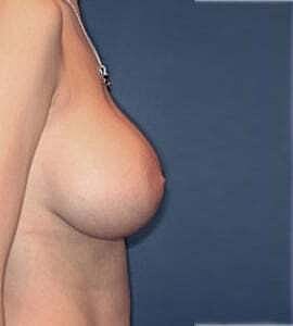 Breast Augmentation Before & After