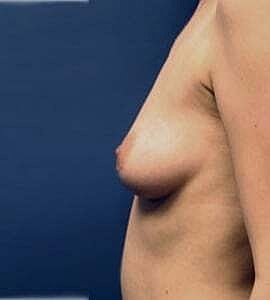 Breast Augmentation Before & After