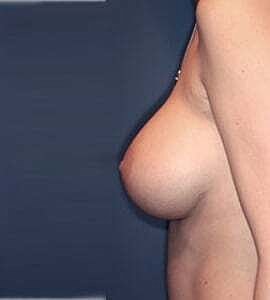 Breast Augmentation Before & After