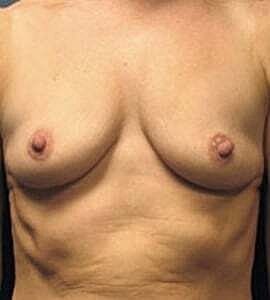 Breast Augmentation Before & After