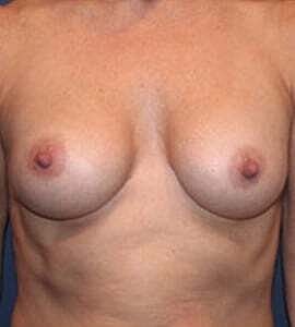 Breast Augmentation Before & After