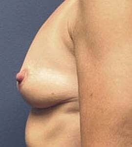 Breast Augmentation Before & After