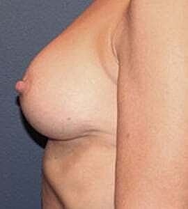 Breast Augmentation Before & After