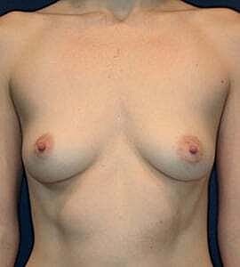 Breast Augmentation Before & After
