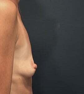 Breast Augmentation Before & After