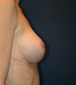 Breast Augmentation Before & After
