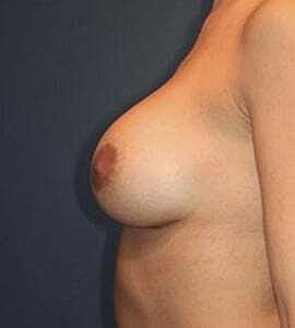 Breast Augmentation Before & After