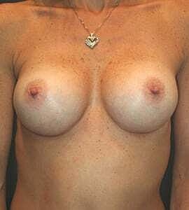 Breast Augmentation Before & After