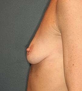 Breast Augmentation Before & After