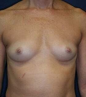 Breast Augmentation Before & After