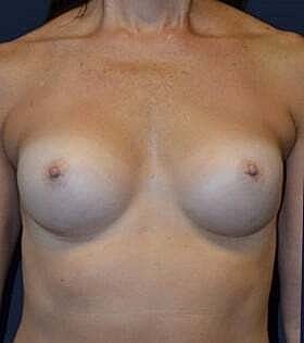 Breast Augmentation Before & After