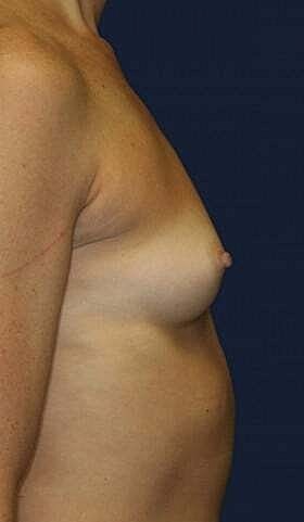 Breast Augmentation Before & After