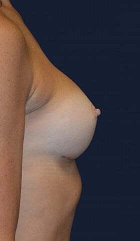 Breast Augmentation Before & After