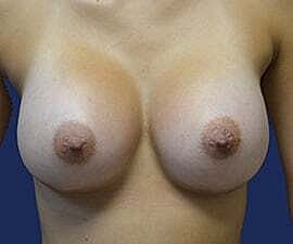 Breast Augmentation Before & After