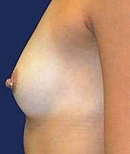 Breast Augmentation Before & After