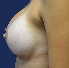 Breast Augmentation Before & After