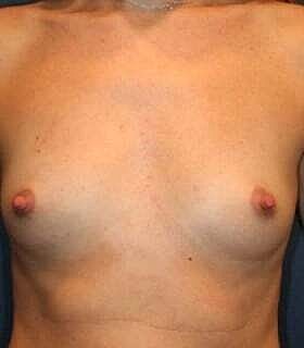 Breast Augmentation Before & After