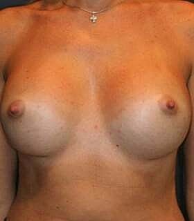 Breast Augmentation Before & After