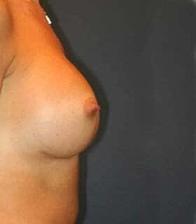 Breast Augmentation Before & After