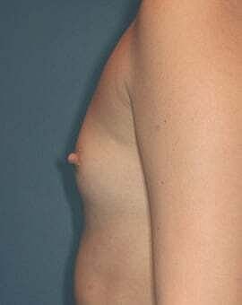 Breast Augmentation Before & After