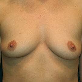Breast Augmentation Before & After