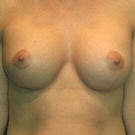 Breast Augmentation Before & After