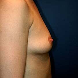 Breast Augmentation Before & After