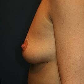 Breast Augmentation Before & After