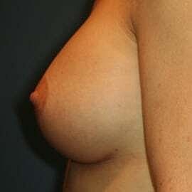 Breast Augmentation Before & After