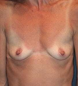 Breast Augmentation Before & After