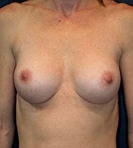 Breast Augmentation Before & After