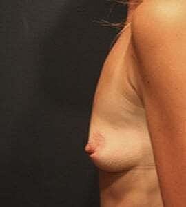 Breast Augmentation Before & After