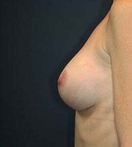 Breast Augmentation Before & After