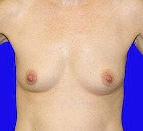 Breast Augmentation Before & After