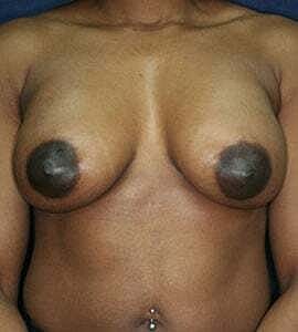 Breast Augmentation Before & After