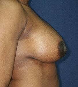 Breast Augmentation Before & After